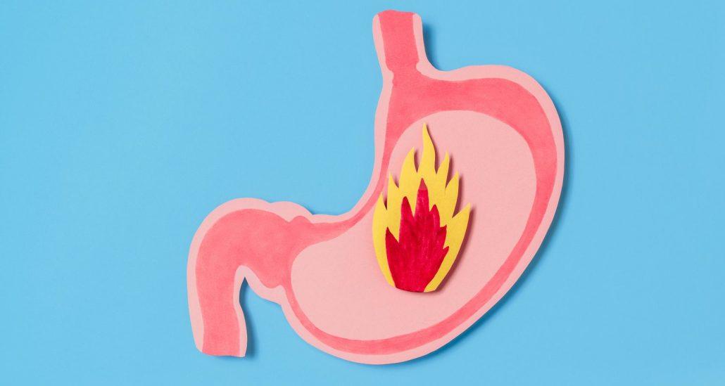 Menopause Triggers Acid Reflux