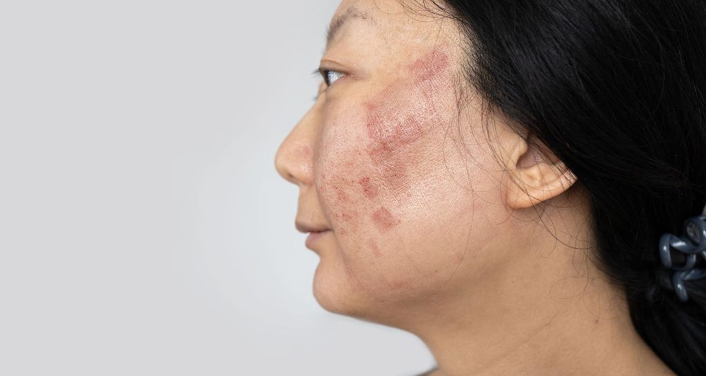 Marijuana for Lupus